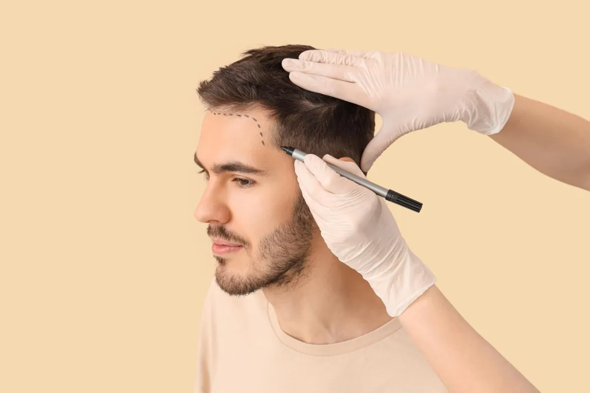 Hair Transplant Recovery Timeline: Week-by-Week Breakdown