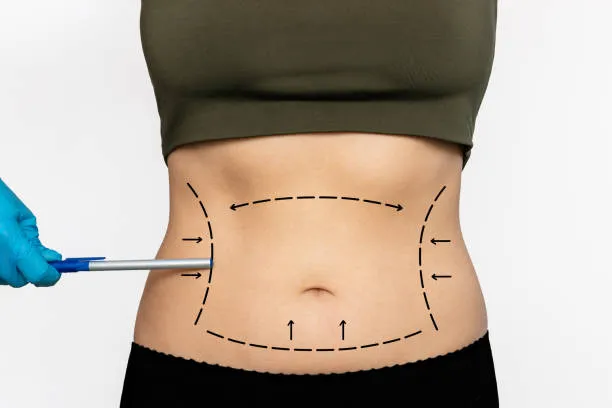 Exploring Liposuction in Riyadh: Safe Paths to Enhanced Curves