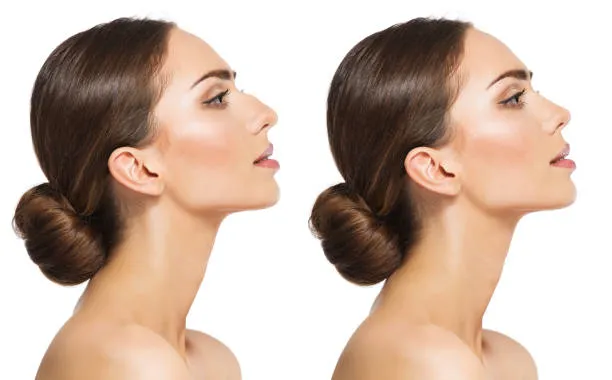 Virtual Rhinoplasty Simulations: Preview Your New Look