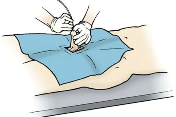 Varicocele Embolization Cost in India: A Complete Guide