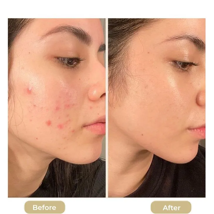 What is the best way to treat acne in Dubai?