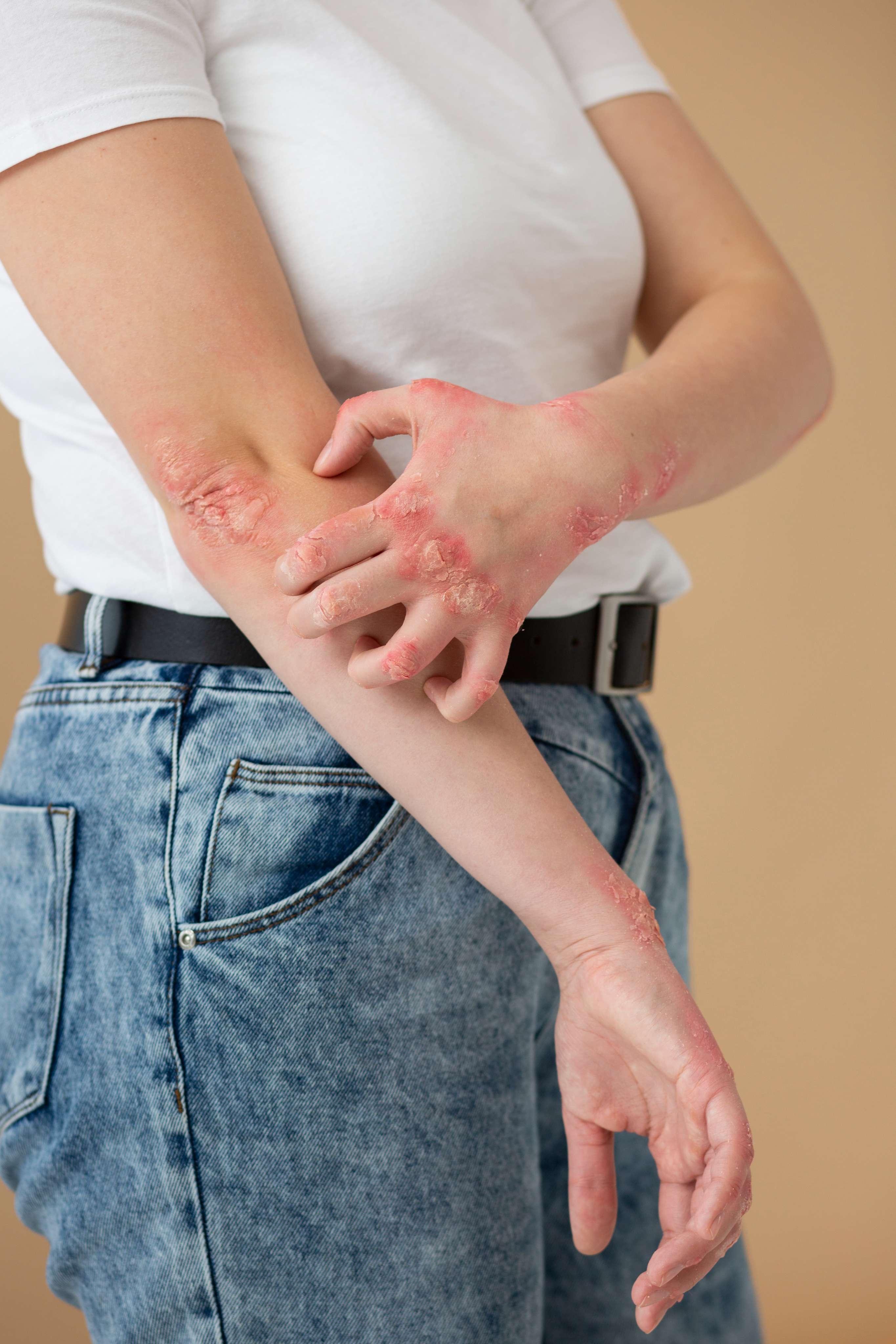 Scabies: Diagnosis, Contagion Risk, and Medical Treatment Options